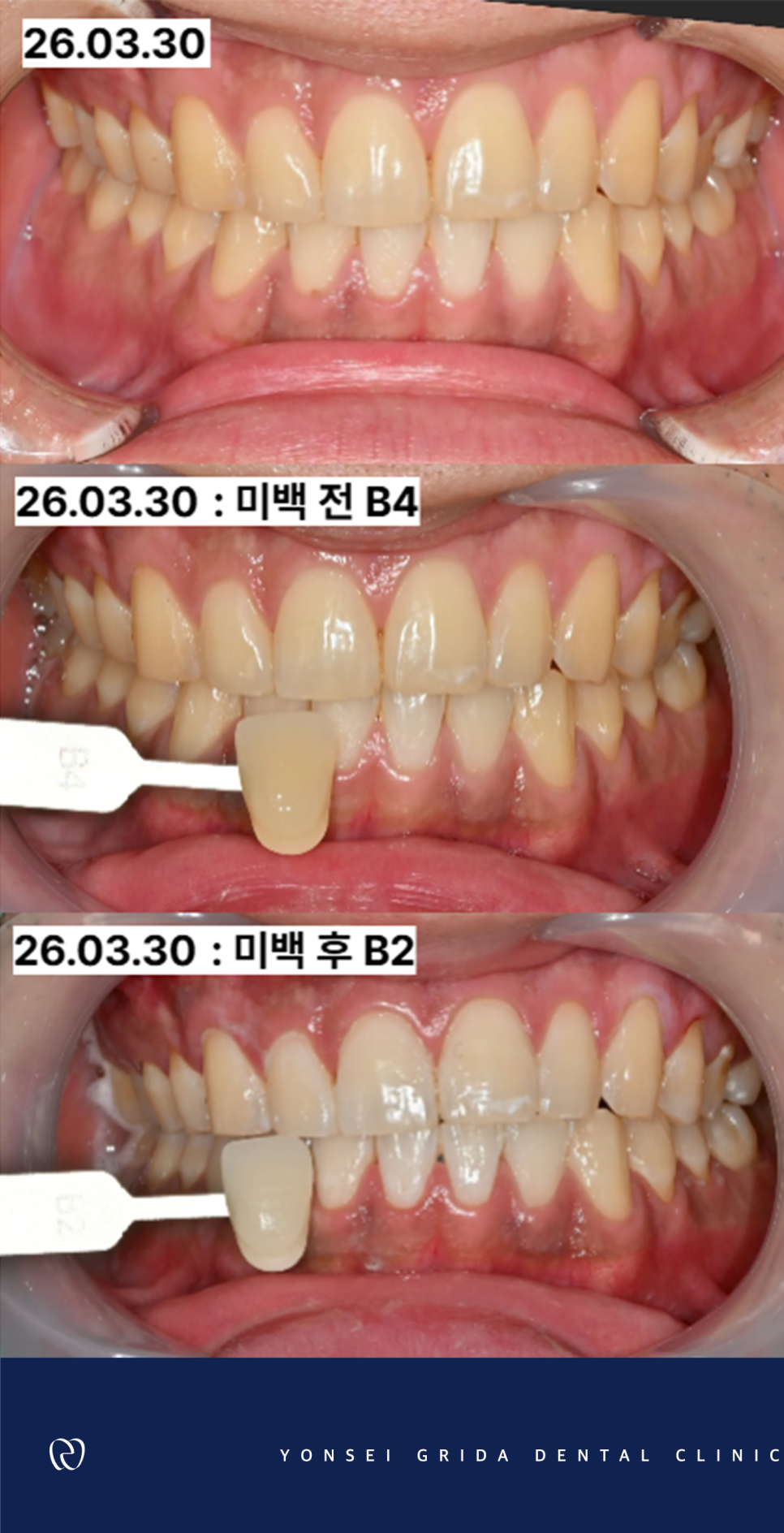 Yeomchang Station Dental Clinic: If You Want to Brighten Your Tooth Color in a Short Time with One-Day Whitening image 6