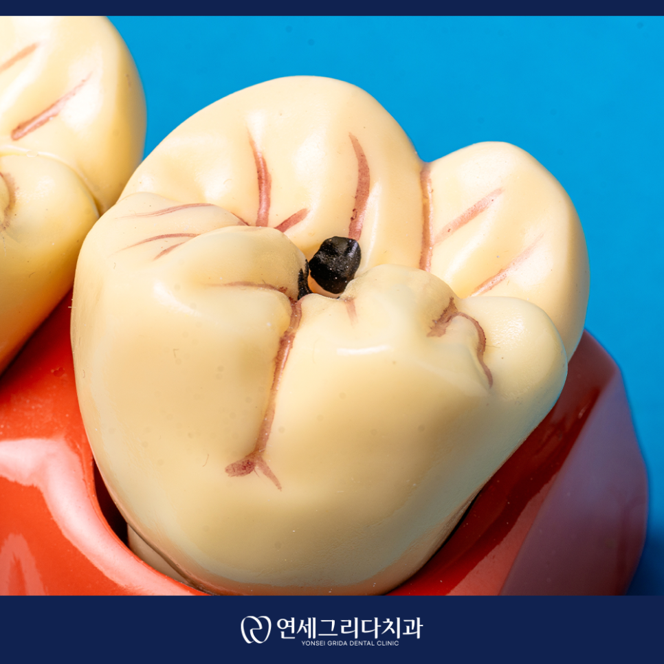 What Is That Black Spot on Your Tooth? Distinguishing Staining from Cavities image 5