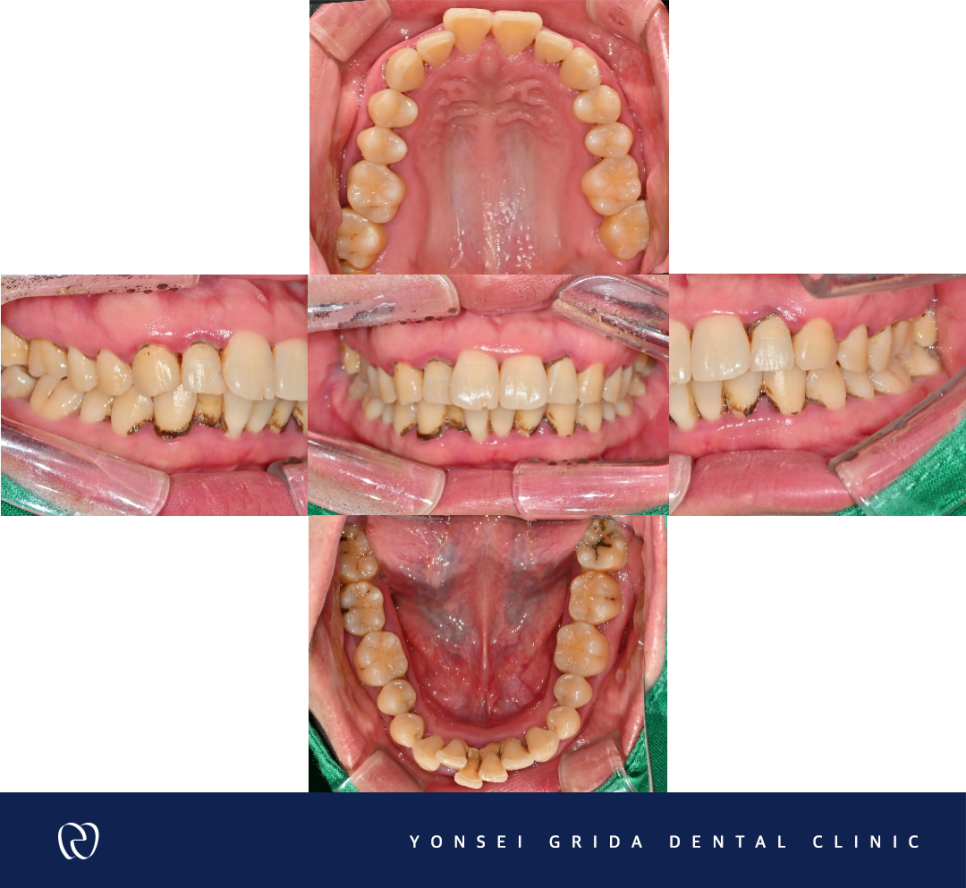 Deungchon Station Dental Clinic: My Front Tooth Broke and My Gums Hurt image 5