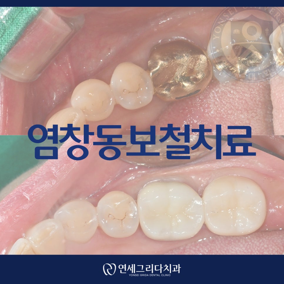염창동보철치료 씹을 때 오른쪽 치아가 시려요 관련 이미지 1
