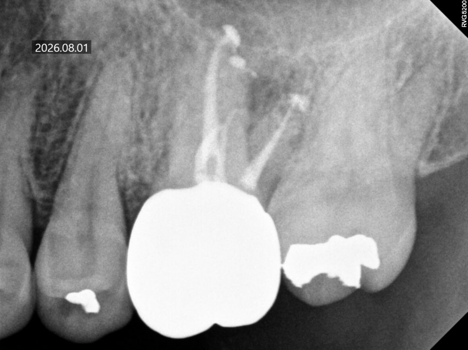 What Happens If You Leave Untreated Cavities Without Symptoms image 5