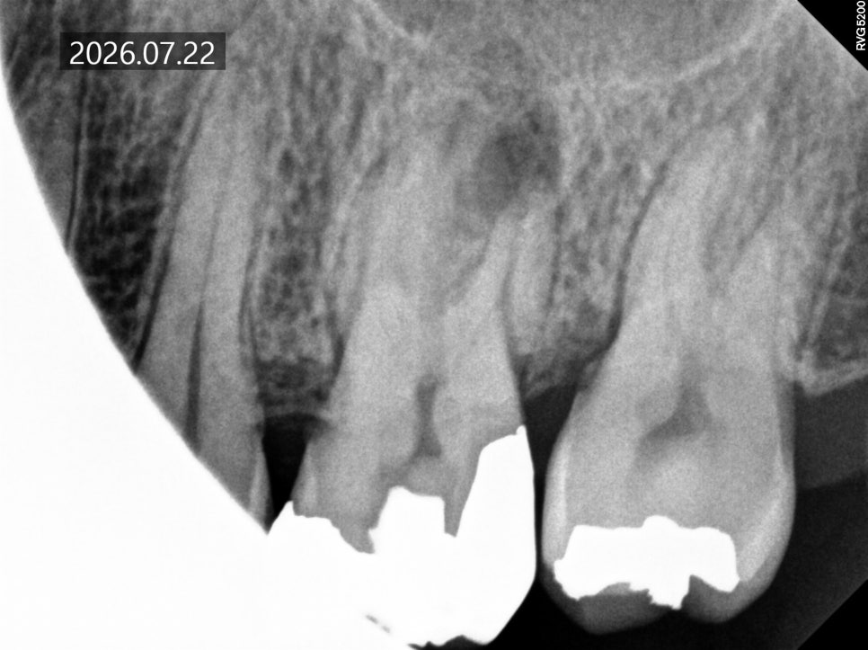 What Happens If You Leave Untreated Cavities Without Symptoms image 2