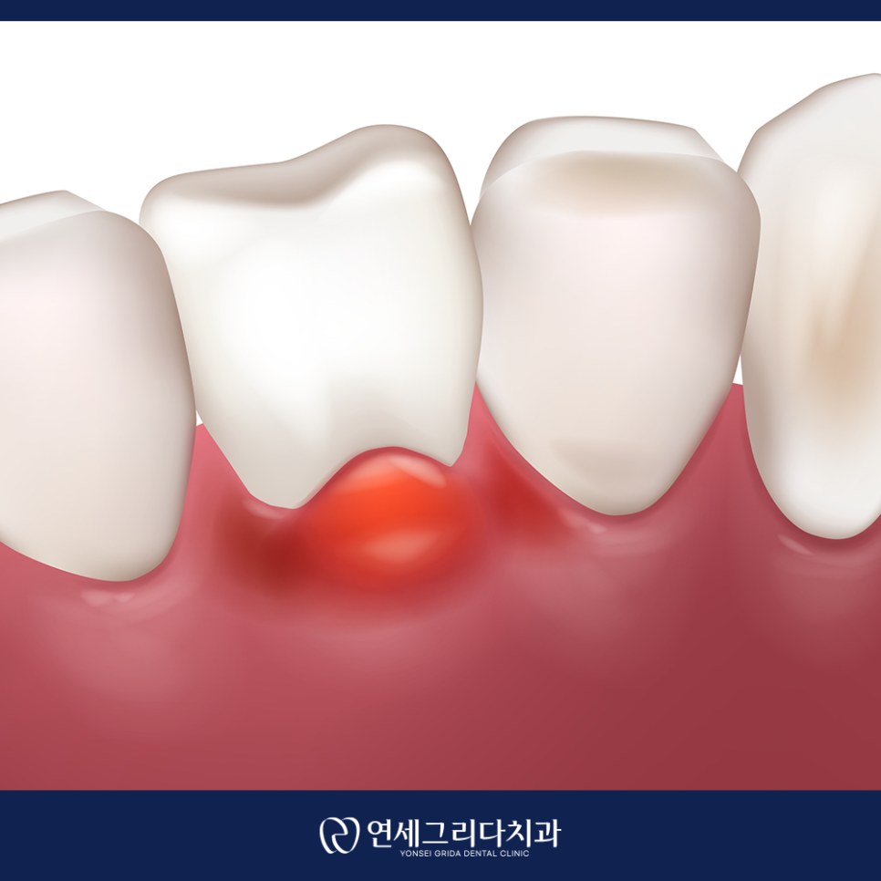 Check If Your Gums Bleed When Brushing: Symptoms of Gingivitis! image 6
