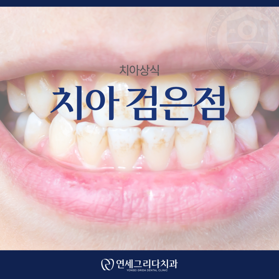 What Is That Black Spot on Your Tooth? Distinguishing Staining from Cavities image 1
