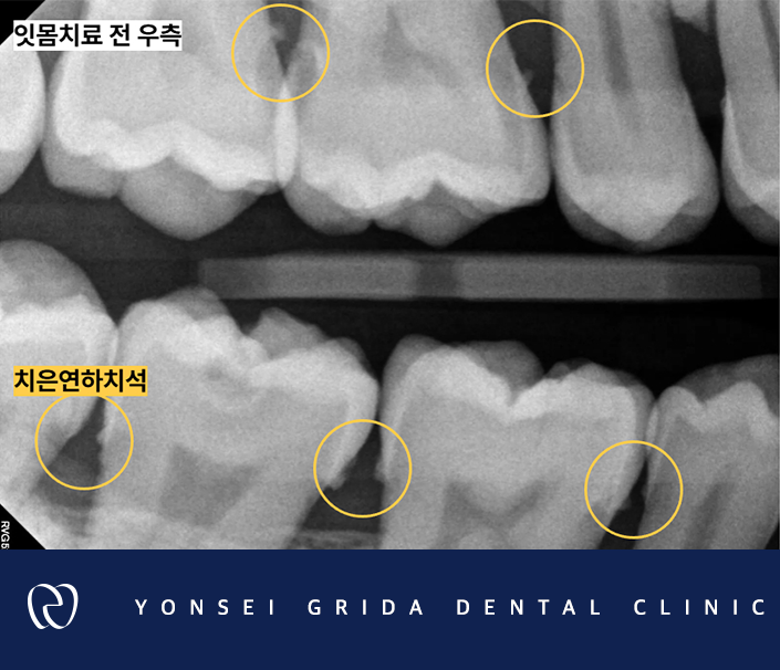 Deungchon Station Dental Clinic: My Front Tooth Broke and My Gums Hurt image 8
