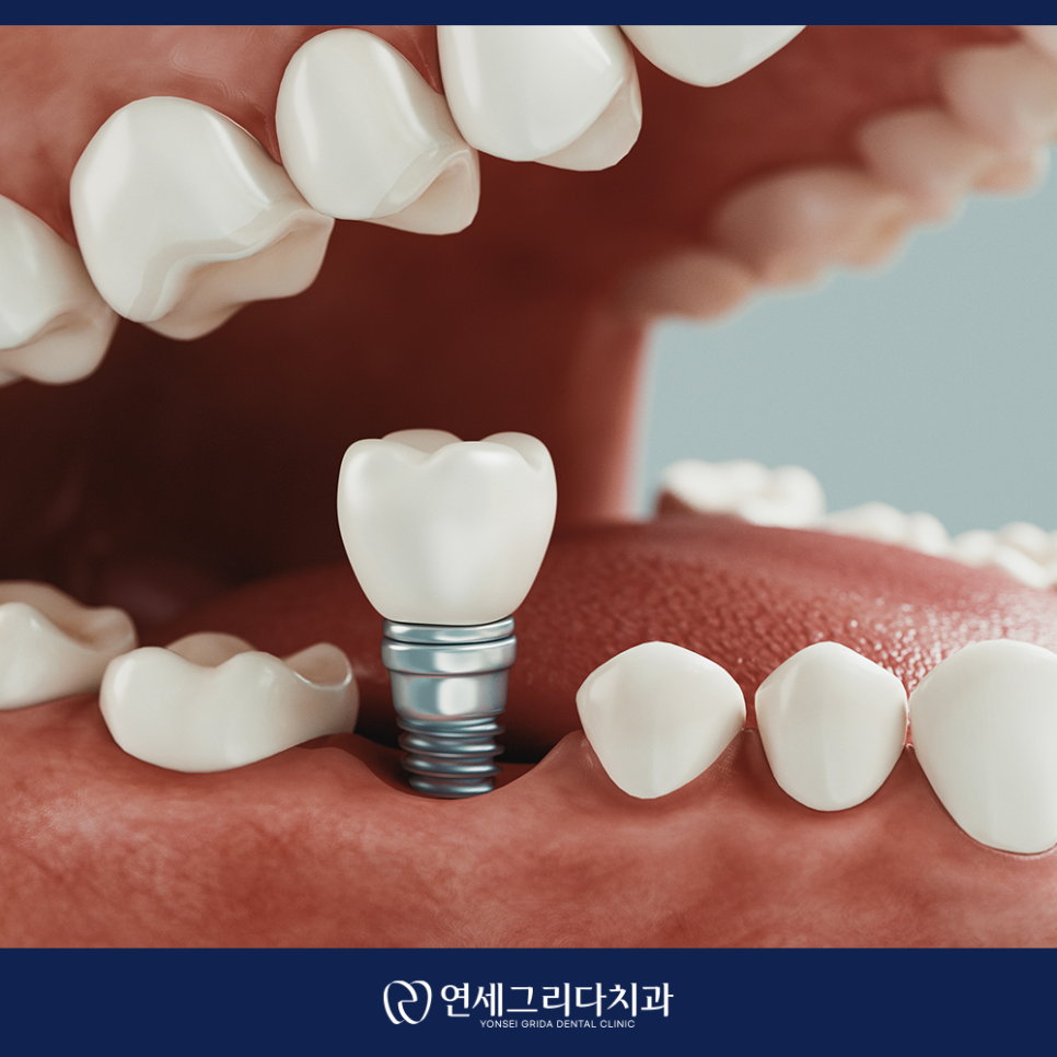 염창동임플란트 치과 선택 전 꼭 확인할 점 관련 이미지 2