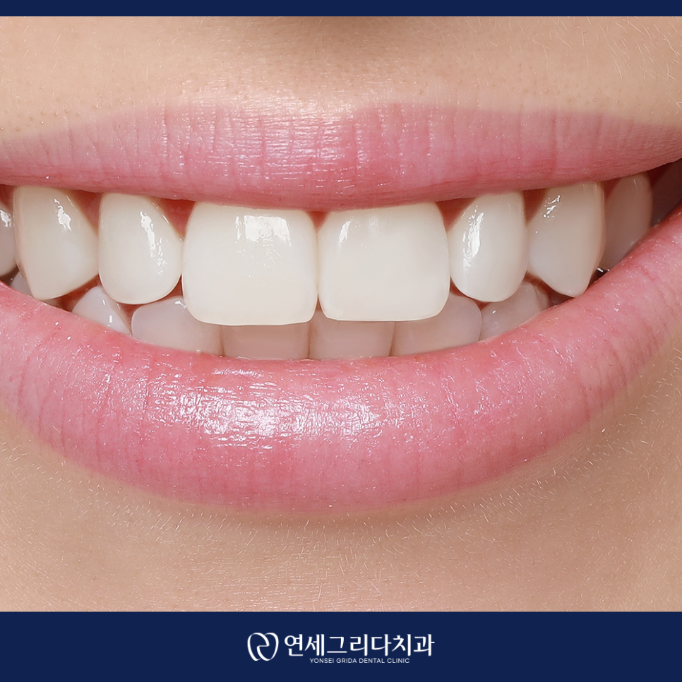 염창동치아미백, 자연스러운 결과를 원한다면 관련 이미지 2