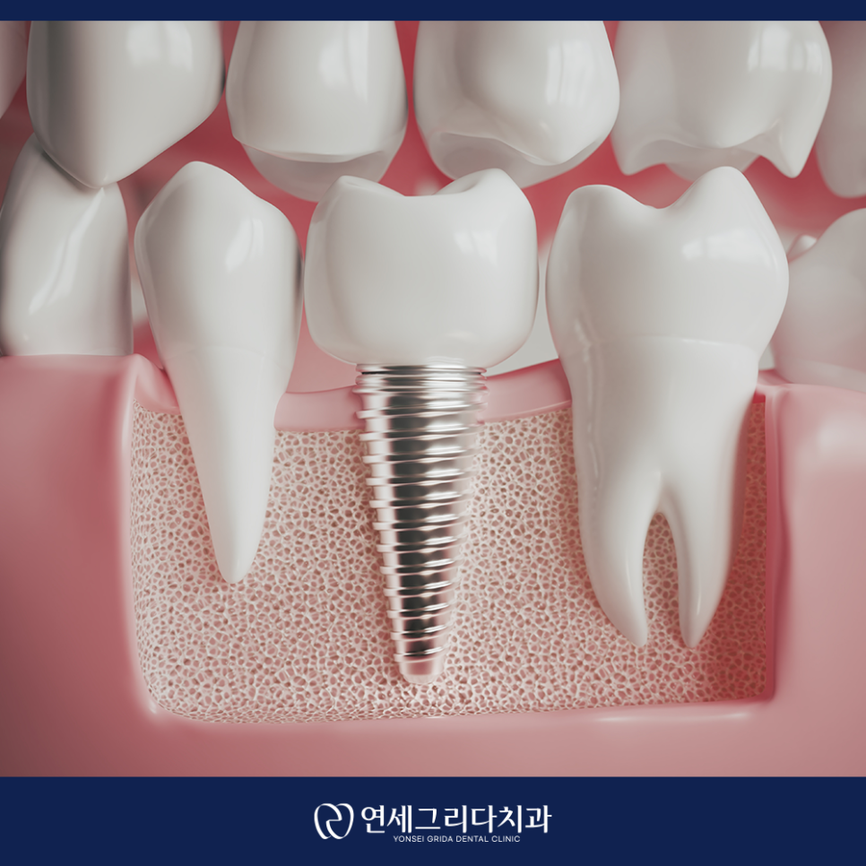 염창동임플란트 치과 선택 전 꼭 확인할 점 관련 이미지 5