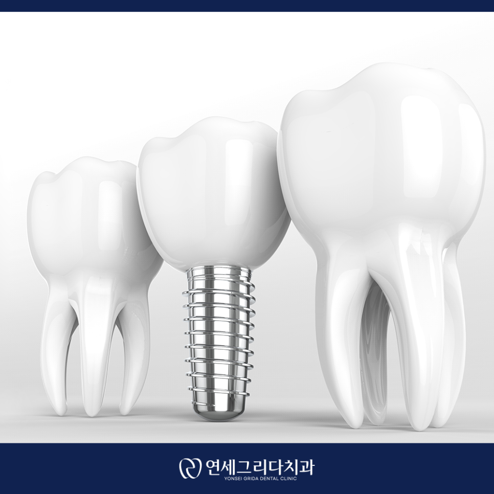 임플란트 후 식사 언제부터 가능할까? 관련 이미지 4