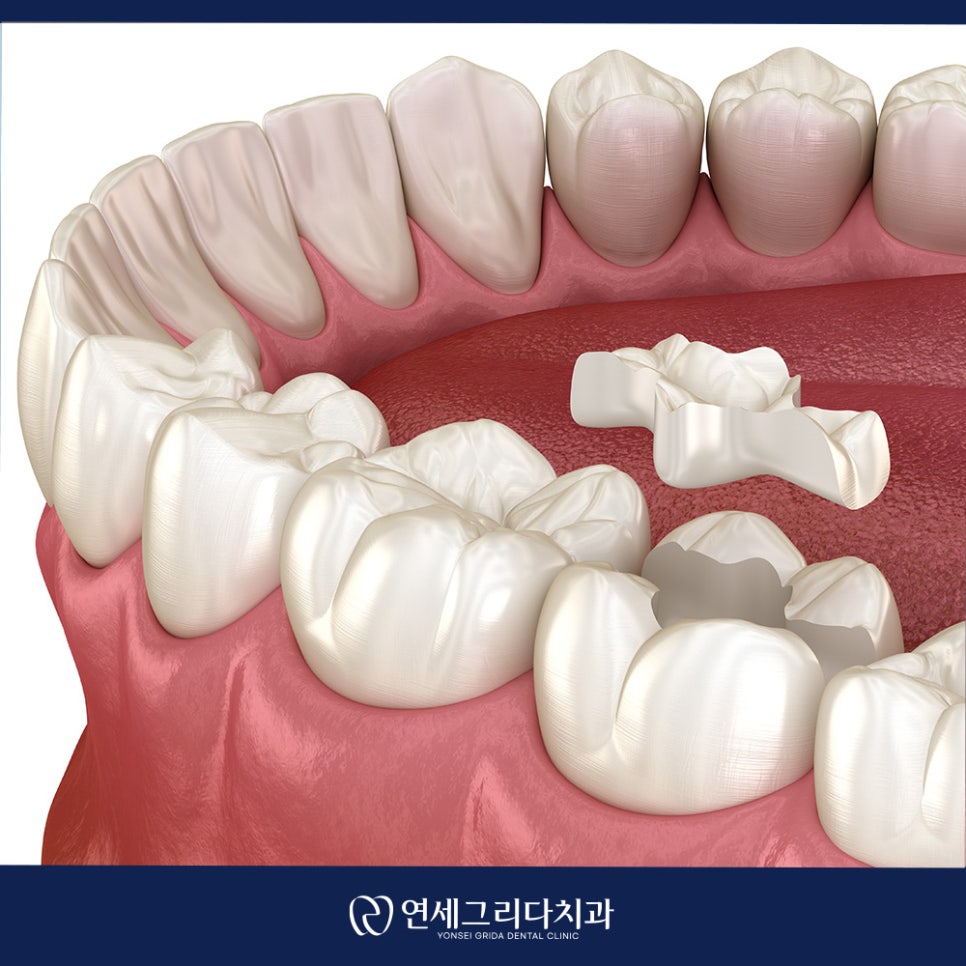 인레이 탈락 재부착이 가능할까요? 관련 이미지 5