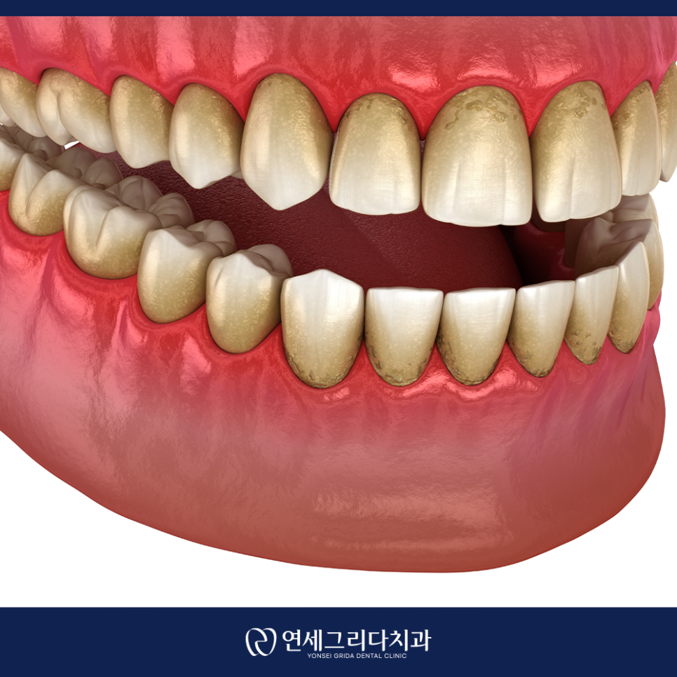 Yeomchang Station Dental Scaling: Manage It Before Tartar Builds Up image 3