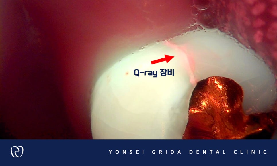 염창동보철치료 씹을 때 오른쪽 치아가 시려요 관련 이미지 5