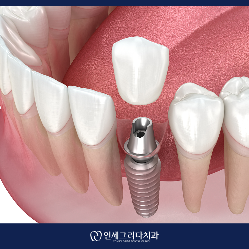 염창역치과, 임플란트 고민이라면 꼭 확인하세요! 관련 이미지 5
