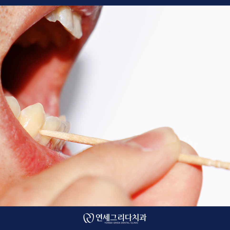 이쑤시개 사용, 치아 사이 음식물 뺄 때 괜찮을까요? 관련 이미지 3