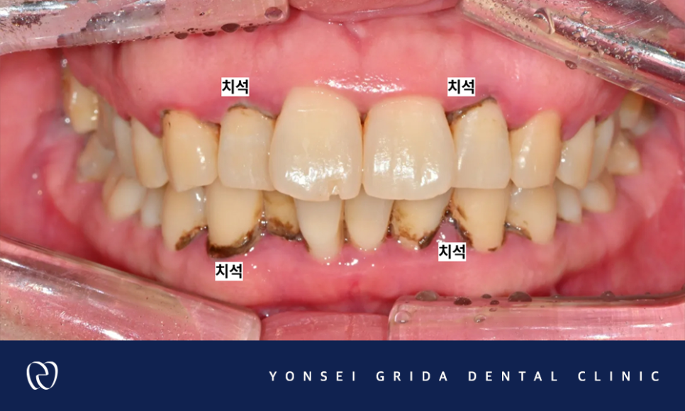 Deungchon Station Dental Clinic: My Front Tooth Broke and My Gums Hurt image 4