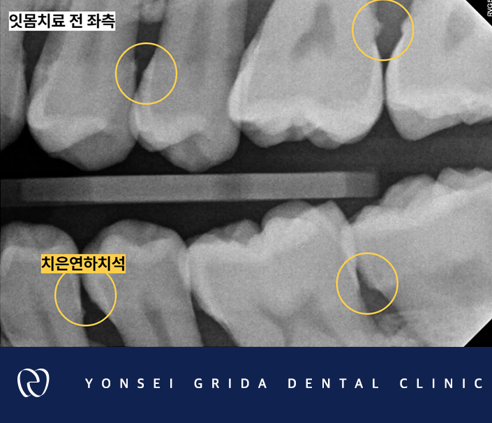 Deungchon Station Dental Clinic: My Front Tooth Broke and My Gums Hurt image 10