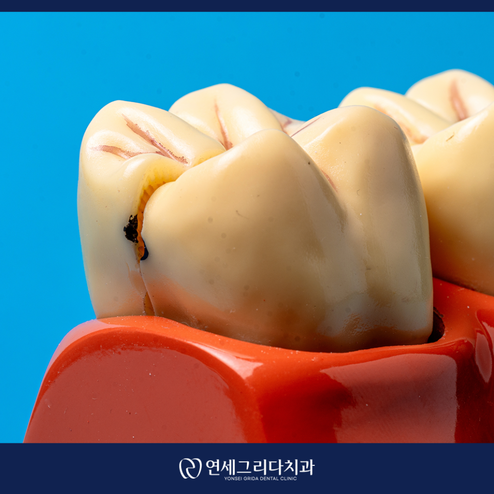 충치치료 통증, 무서워서 미루고 계셨나요? 관련 이미지 3