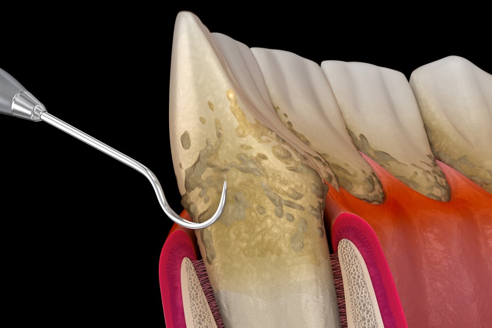 잇몸 부음, 치료 시기를 놓치지 않으려면 관련 이미지 2