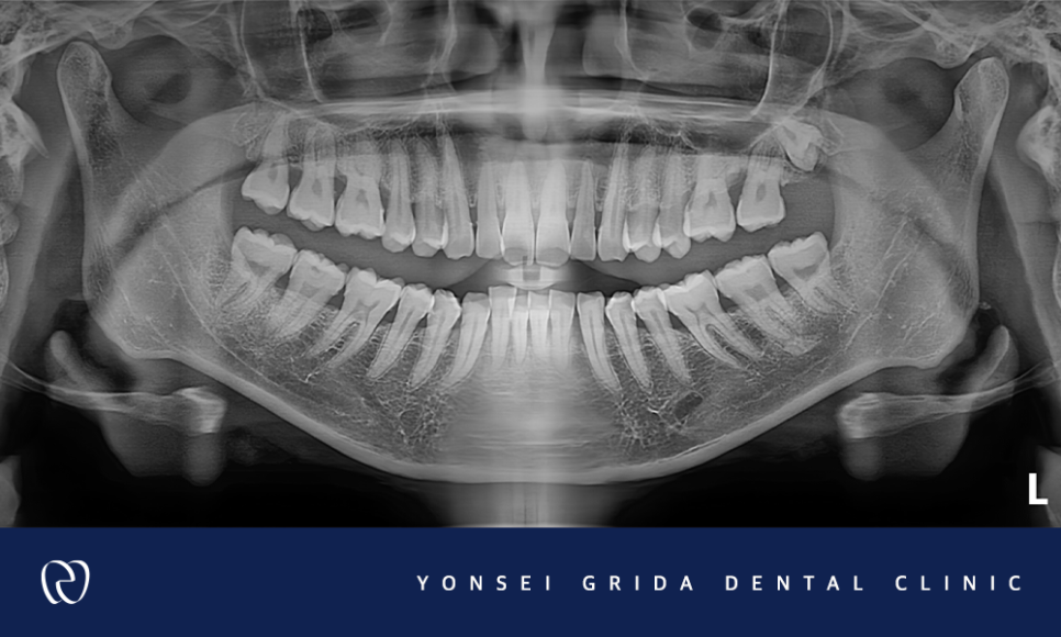 Deungchon Station Dental Clinic: My Front Tooth Broke and My Gums Hurt image 6