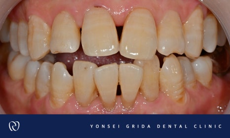 Recommended Dentist in Yeomchang-dong: My Front Teeth Are Chipped and Gapped image 3