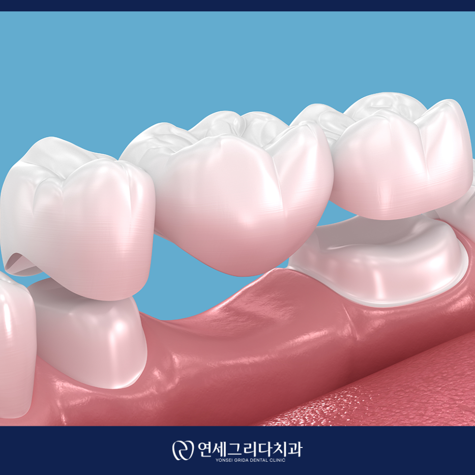 크라운 교체 시기, 이런 증상이 있다면 교체 신호 관련 이미지 5