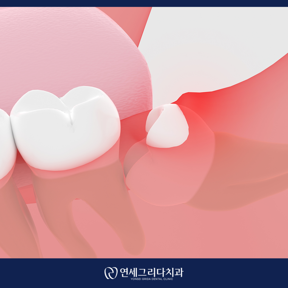 염창동치과, 사랑니 통증 참고만 계시다면? 관련 이미지 6