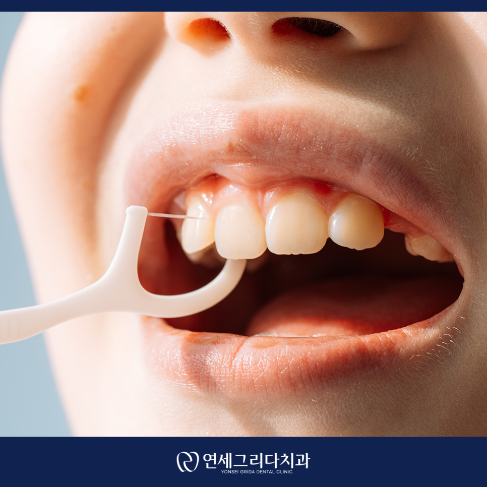 치간칫솔 사용법, 제대로 알고 쓰면 달라집니다! 관련 이미지 2