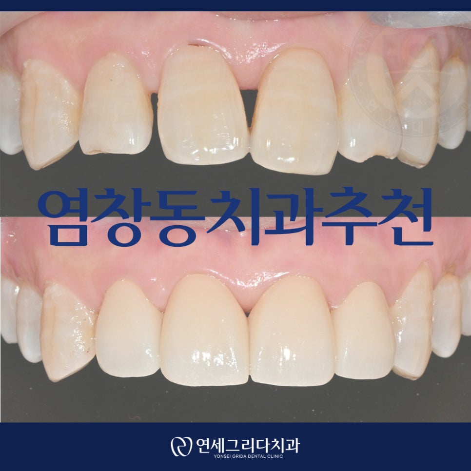Recommended Dentist in Yeomchang-dong: My Front Teeth Are Chipped and Gapped image 1