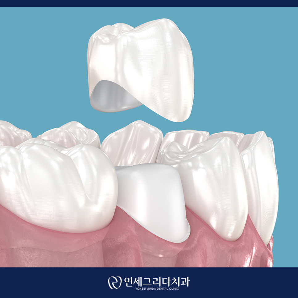 크라운 교체 시기, 이런 증상이 있다면 교체 신호 관련 이미지 2