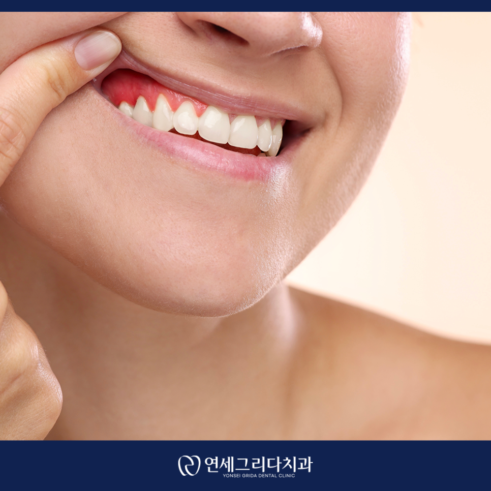 Check If Your Gums Bleed When Brushing: Symptoms of Gingivitis! image 3