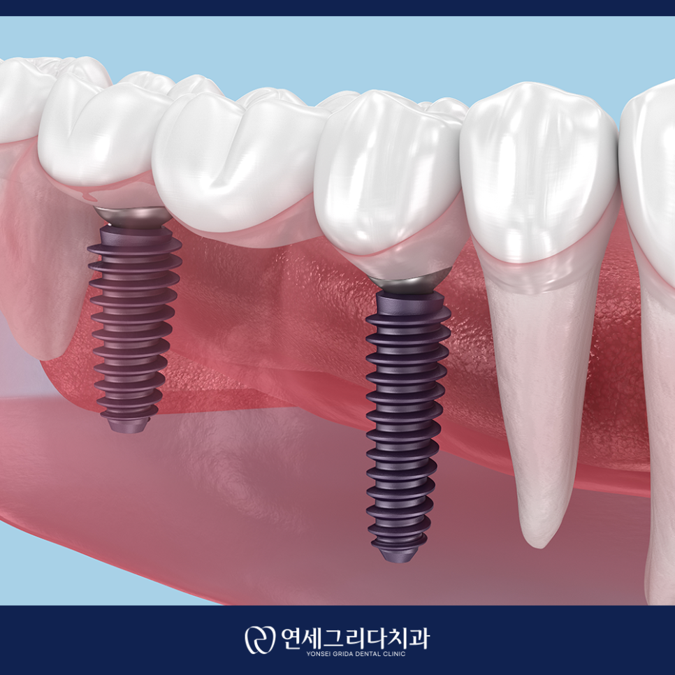 염창동임플란트 치과 선택 전 꼭 확인할 점 관련 이미지 7
