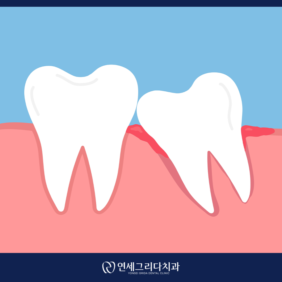 염창동치과, 사랑니 통증 참고만 계시다면? 관련 이미지 2
