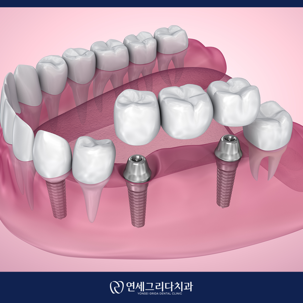 임플란트 후 식사 언제부터 가능할까? 관련 이미지 5