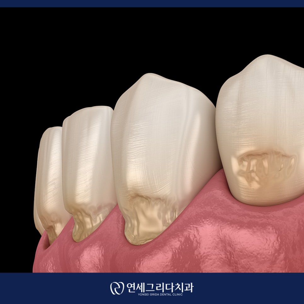 치경부마모증 시린 증상이 생겼다면? 관련 이미지 2