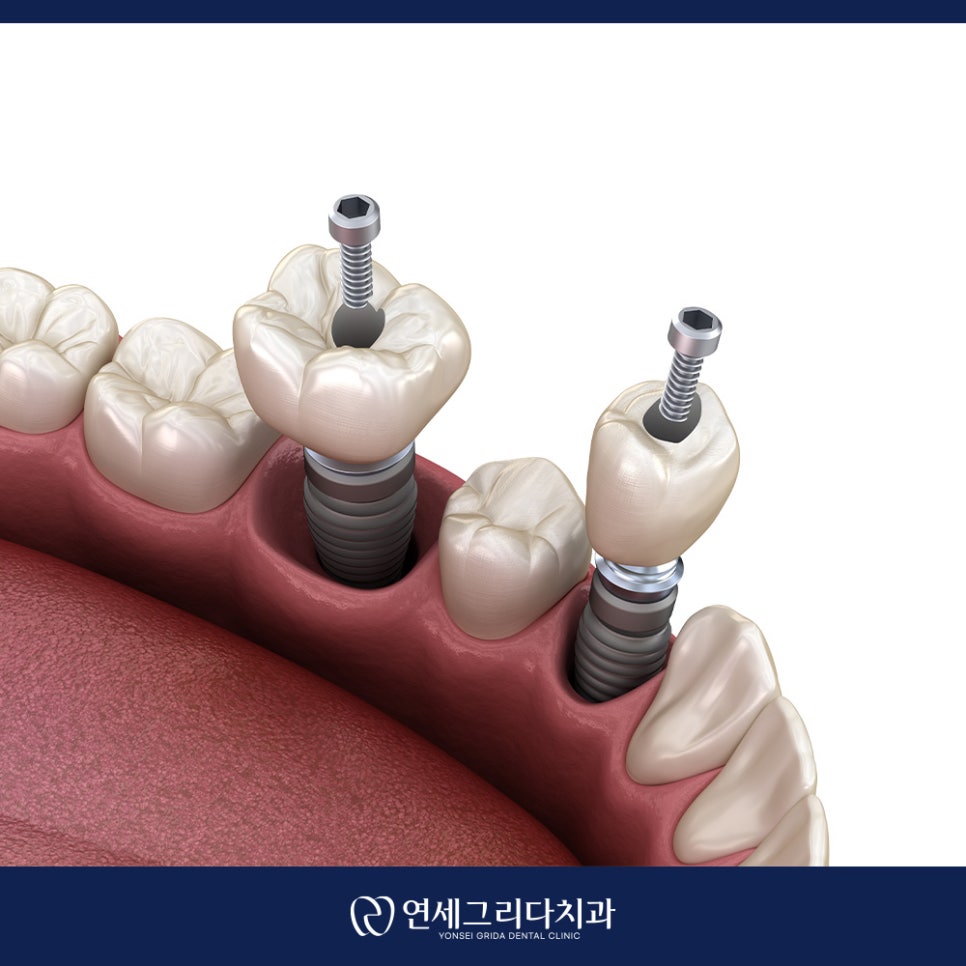 임플란트 흔들림 방치하면 생길 수 있는 문제는? 관련 이미지 4