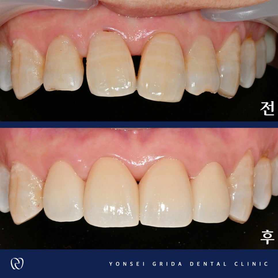 Recommended Dentist in Yeomchang-dong: My Front Teeth Are Chipped and Gapped image 8
