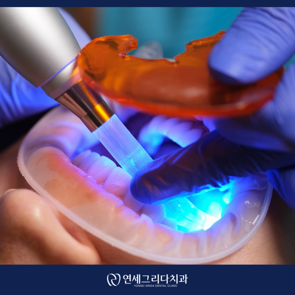 치경부마모증 시린 증상이 생겼다면? 관련 이미지 5