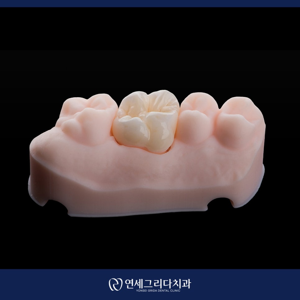 크라운 후 시림 계속 지속된다면? 관련 이미지 5