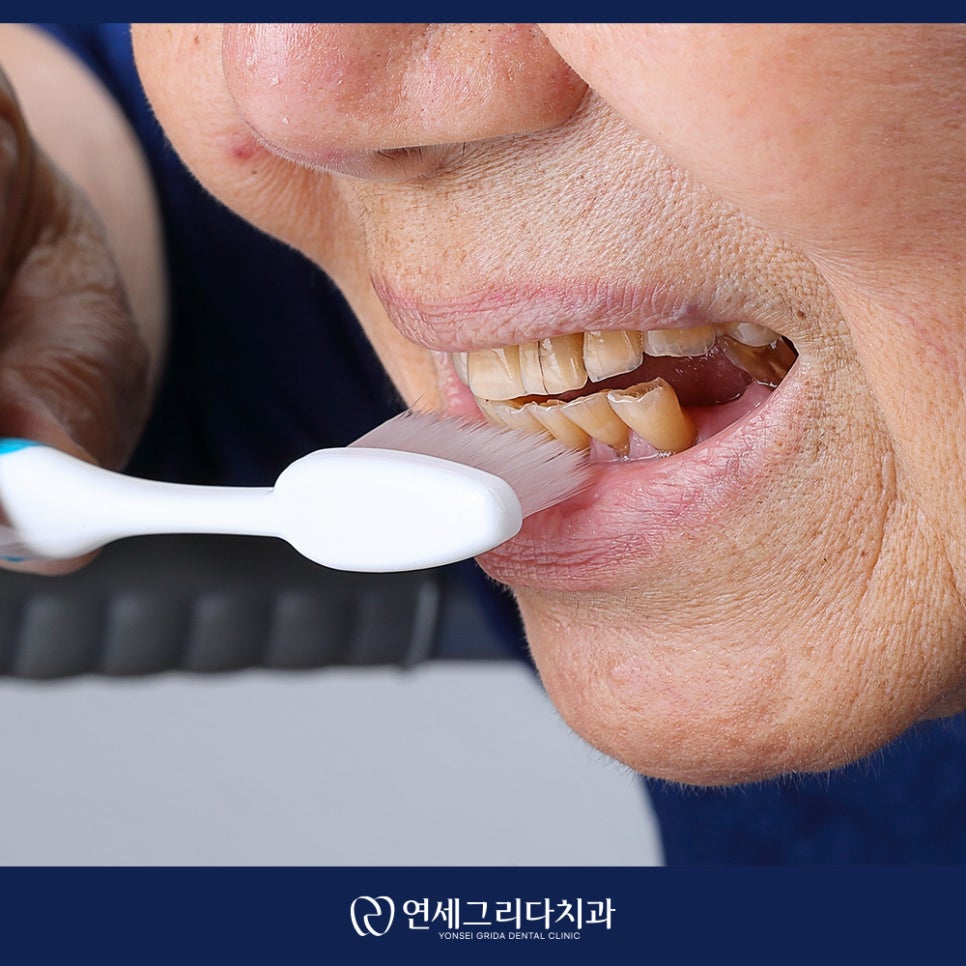 치경부마모증 시린 증상이 생겼다면? 관련 이미지 4