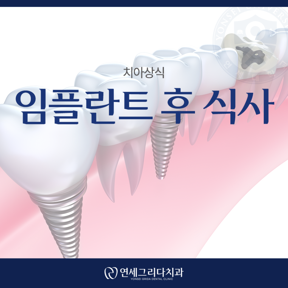 임플란트 후 식사 언제부터 가능할까? 관련 이미지 1