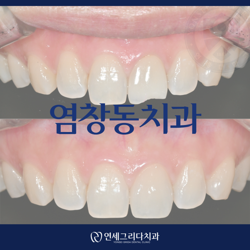 Yeomchang-dong Dental Clinic: The Crown I Had Treated Before Has Broken image 1