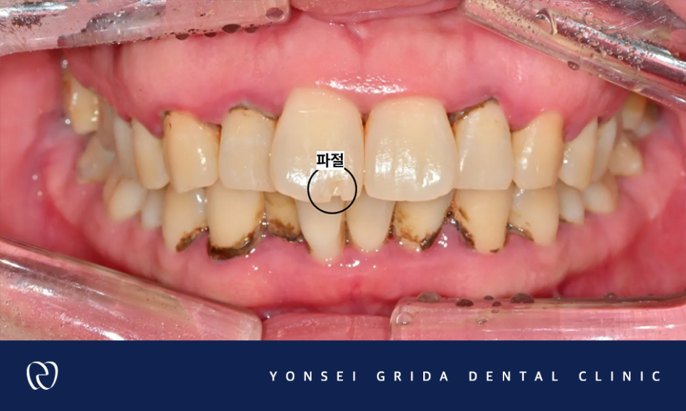Deungchon Station Dental Clinic: My Front Tooth Broke and My Gums Hurt image 3