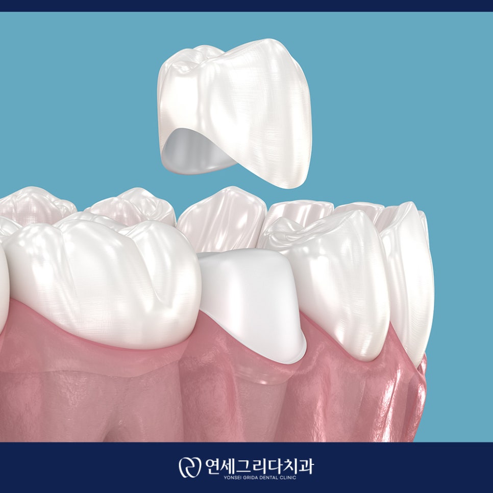 신경치료 후 보철 미루면 생기는 문제는? 관련 이미지 6