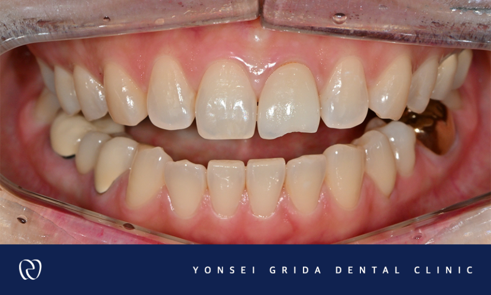 Yeomchang-dong Dental Clinic: The Crown I Had Treated Before Has Broken image 2
