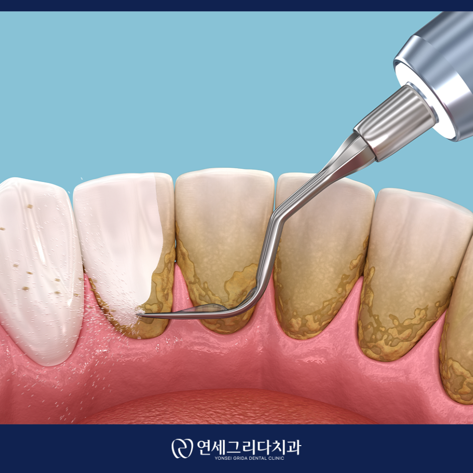 Yeomchang Station Dental Scaling: Manage It Before Tartar Builds Up image 4