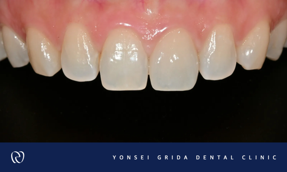 Yeomchang-dong Dental Clinic: The Crown I Had Treated Before Has Broken image 6