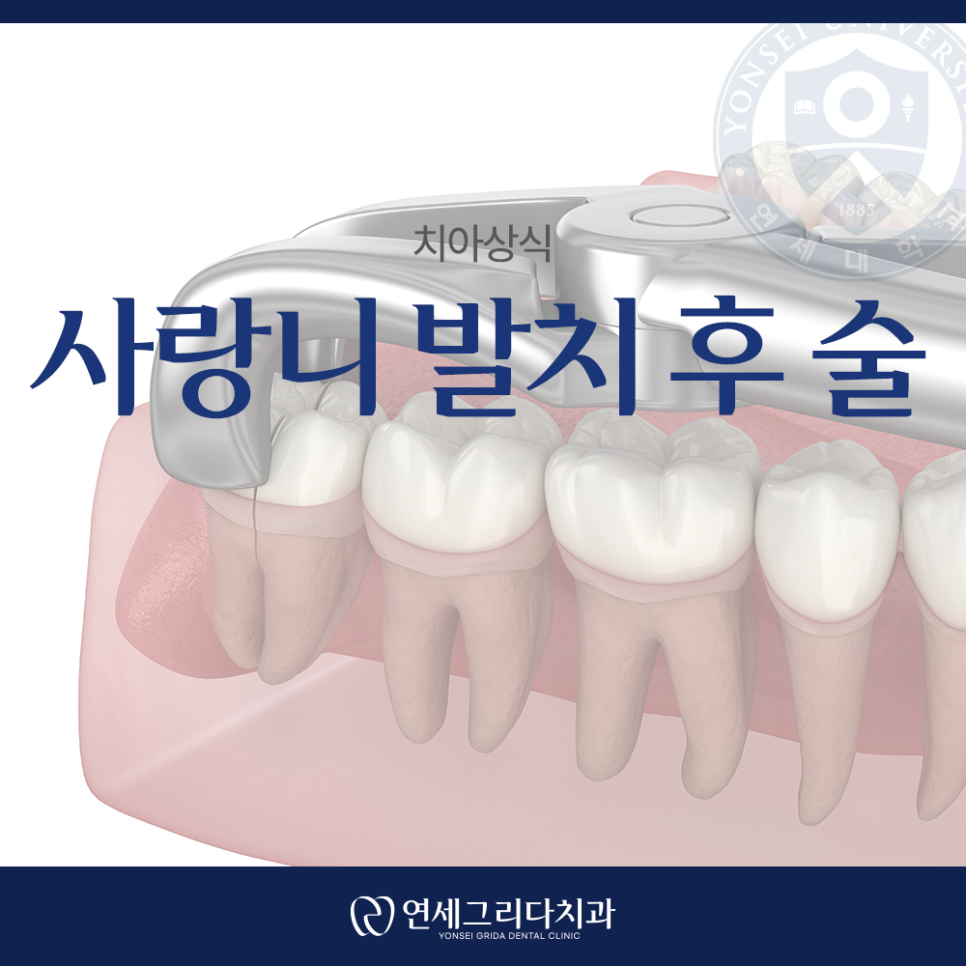 사랑니 발치 후 술을 참아야 하는 이유와 음주 가능 시기 관련 이미지 1