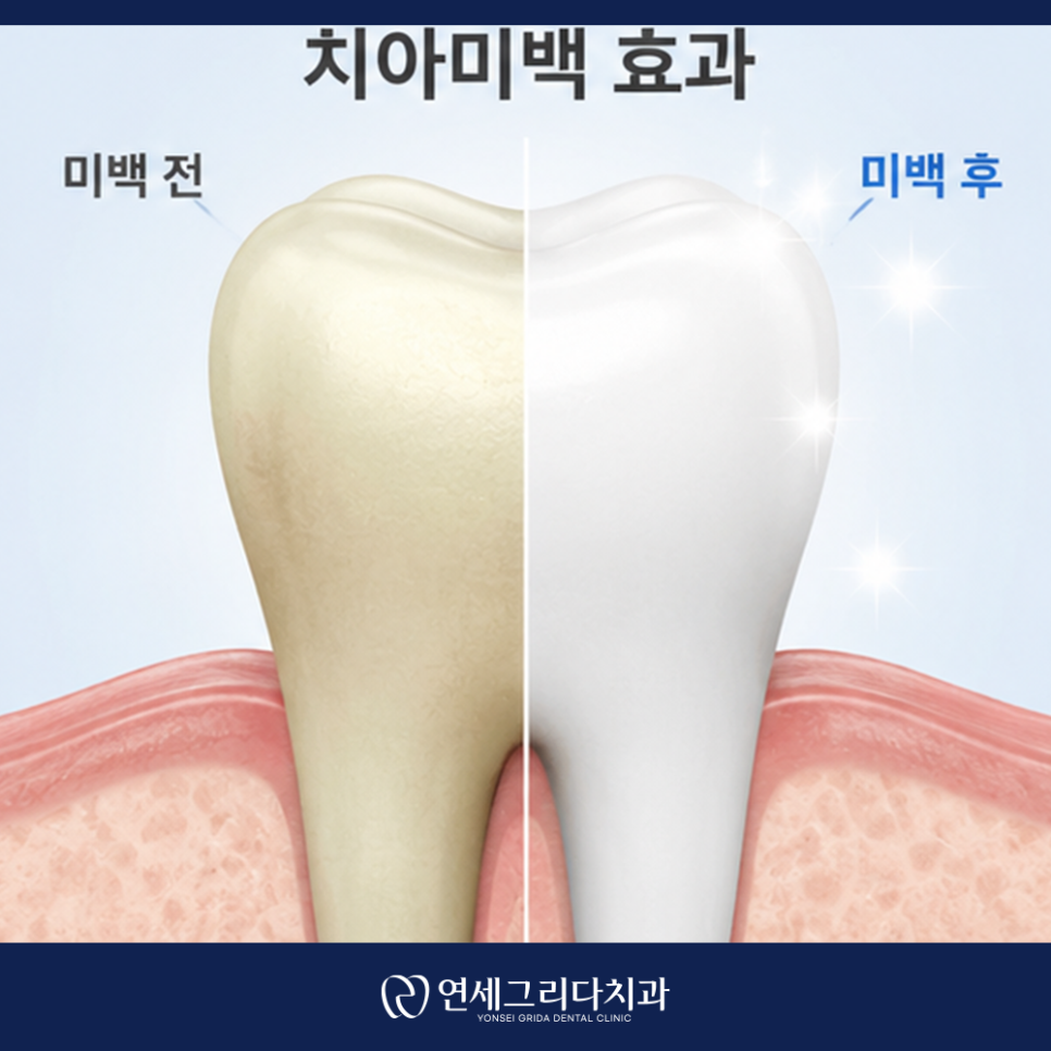 염창동치아미백, 자연스러운 결과를 원한다면 관련 이미지 4