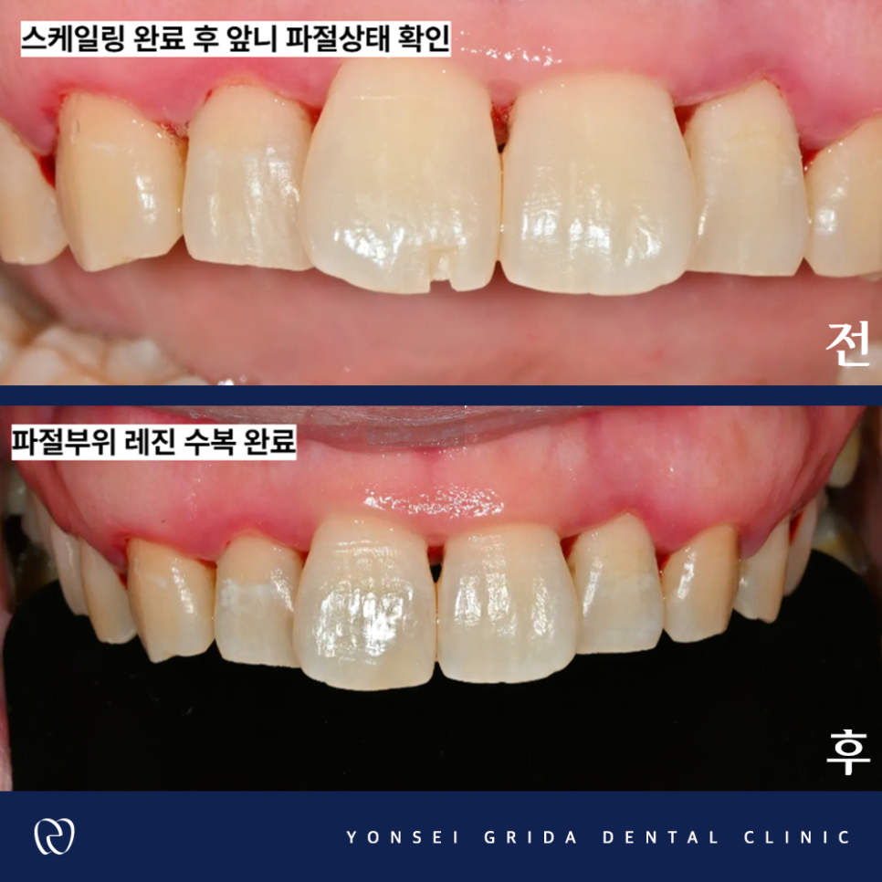 Deungchon Station Dental Clinic: My Front Tooth Broke and My Gums Hurt image 7