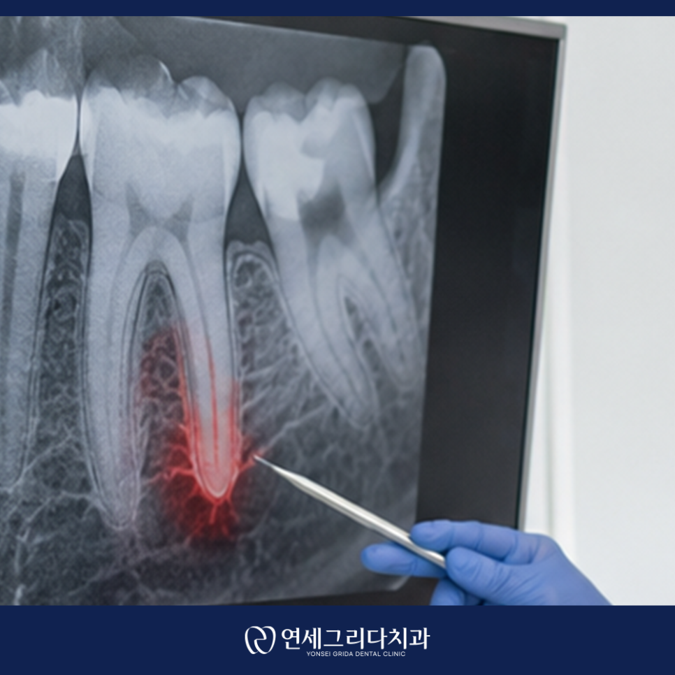 Yeomchang Station Root Canal Treatment: Addressing the Cause of Pain First image 2